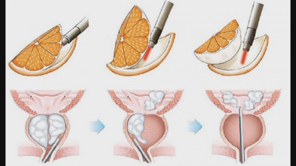 Prostat Tedavisi